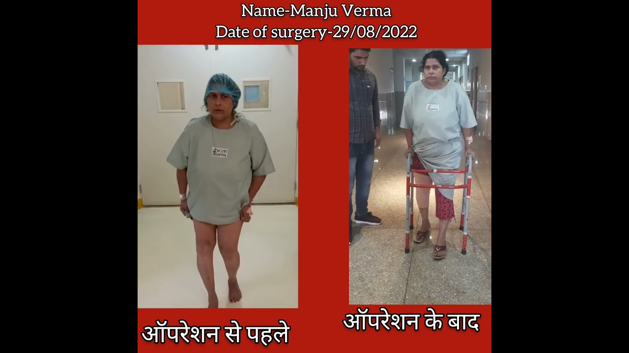 Knee Replacement Surgery - pt name Manju Verma #kneepain #kneereplacementsurgery #drtarunsolanki
