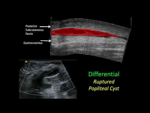 Ultrasound of the Lower Extremity: Muscle Pathology