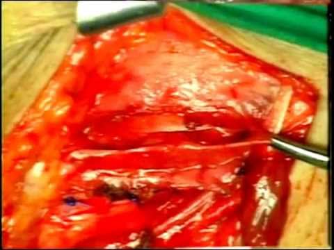 Recurrent groin inguinal hernia repair surgery without mesh-Dr. Desarda Repair