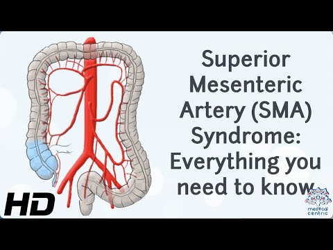 From Diagnosis to Recovery: A Journey through Superior Mesenteric Artery Syndrome