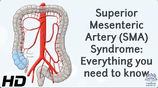 From Diagnosis to Recovery: A Journey through Superior Mesenteric Artery Syndrome