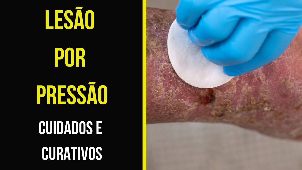 LESÃO POR PRESSÃO: CUIDADOS E CURATIVOS.