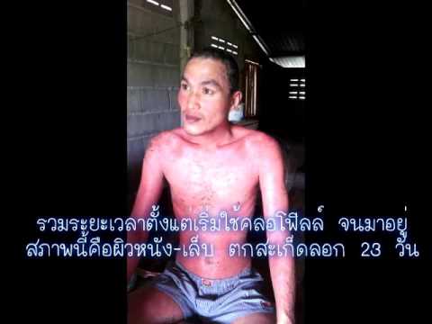 กลากรอบดวงตา เลือดจากโรคสะเก็ดเงินล้าง