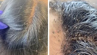 Hair Clinic Remove Hundreds Of Lice From Client&#39;s Head