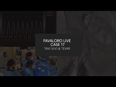 Favaloro Live Case N° 17 - TAVI (ViV) & TEVAR