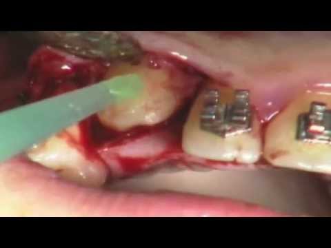 Trattamento della malattia degenerativa del disco della gravidanza toracica Osteoartrite del ginocchio dellesercito 2 gradi