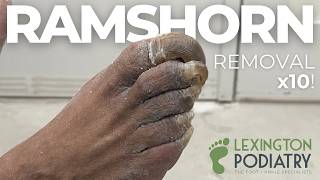 10 Ramshorns vs 1 Podiatrist (PART 1)