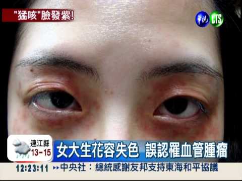 用力咳嗽血管爆 眼周長出"紫斑蝶"