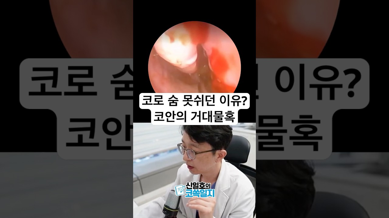 코로 숨 못 쉬던 이유? 코안의 거대 물혹