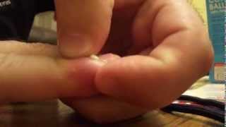 How to Drain an Infected Hangnail