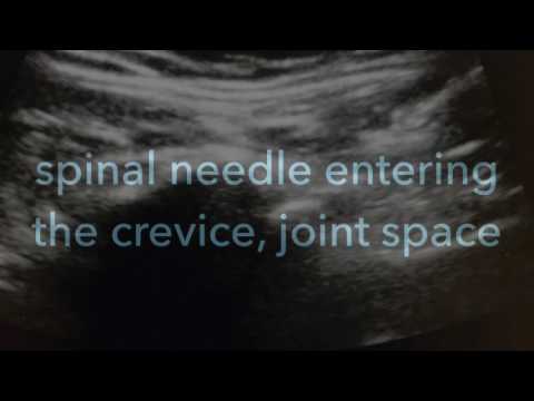 Ultrasound Guided Sacroiliac Joint injection