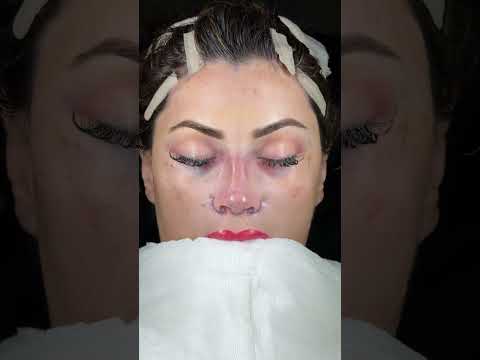 Barbie Nose + Temporal Lift (Ponytail Lift)