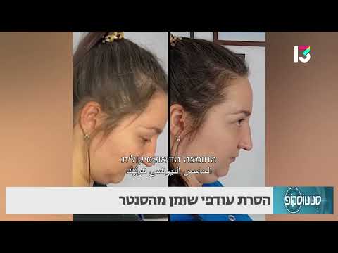 הסרת עודפי שומן מהסנטר
