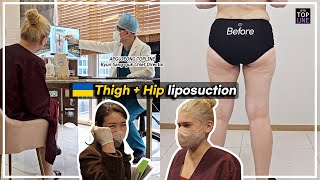 Thigh + Hip liposuction [허벅지+엉덩이지방흡입]