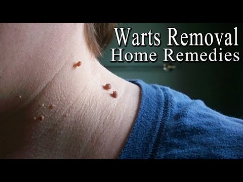 warts treatment on neck