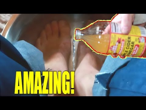 PUT APPLE CIDER VINEGAR ON YOUR FEET AND SEE WHAT HAPPENS!