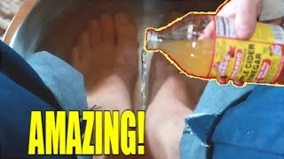 PUT APPLE CIDER VINEGAR ON YOUR FEET AND SEE WHAT 