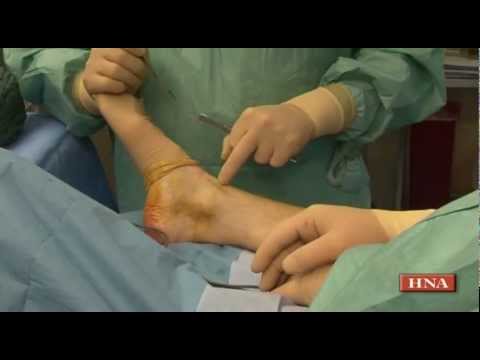 Was ist die Behandlung von Prostatitis in der Home-Video-Umgebung Behandlung der chronischen Prostatitis