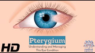 Eyes on Pterygium: How to Protect and Preserve Your Vision