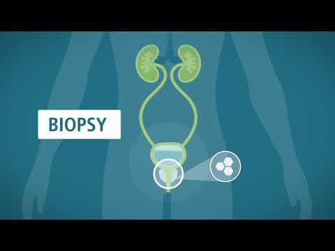 Prostate Biopsy: What You Should Know – Urology Care Foundation