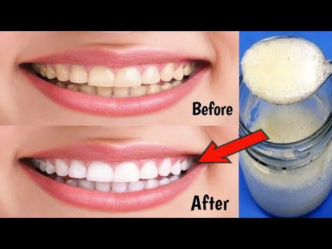 Teeth whitening in seconds removes yellowing and removes accumulated tartar 💯 / How to whiten teeth