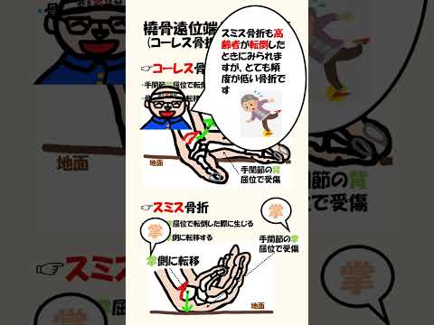 骨折について詳しく解説