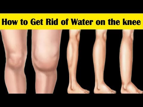 suprapatellar térdtáska kezelés