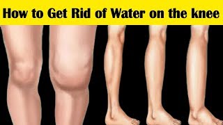 How to Get Rid of Water on the Knee || 6 Home Remedies for Water on the Knee Symptoms