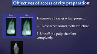 Access Cavity Preparation – Endodontics