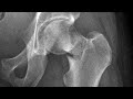 Femoral Neck Fracture l Causes l Signs and Symptoms l Diagnosis l Treatment