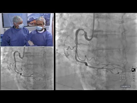 Complex PCI in high bleeding risk patients, the way forward!  - GulfPCR-GIM 2023