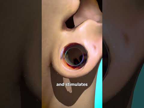 How Ear Gauges Can Tear Your Ears 👂
