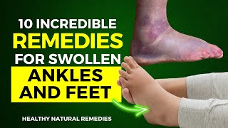 10 Incredible Remedies For Swollen Ankles and Feet