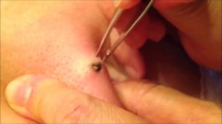 20 Year Old Blackhead Removed