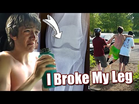 I Broke My Leg! 😱🤕
