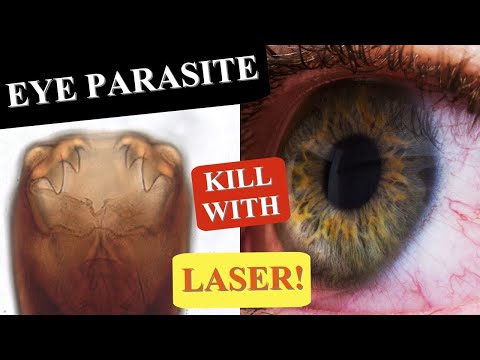 EYE PARASITES | HOW TO KILL A PARASITE IN THE EYE