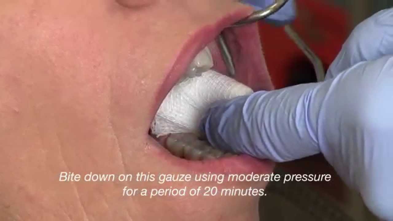 Dental Post Operative Care Video 1