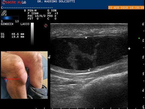 I produttori di protesi articolari del ginocchio Spalla tendinite articolazione