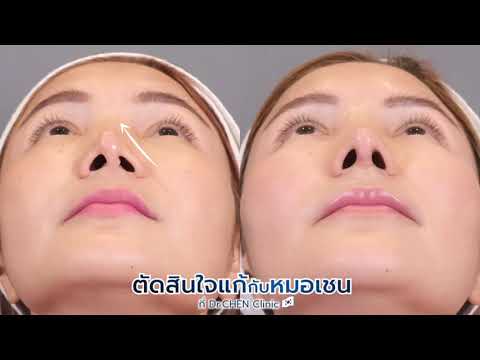 5 สัญญาณ อันตราย ต้องรีบแก้จมูกอย่างเร่งด่วน