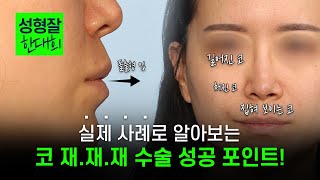 세 번째 코수술, 얼굴의 인상이 달라졌습니다 | 코끝·비주각·복코 교정 사례