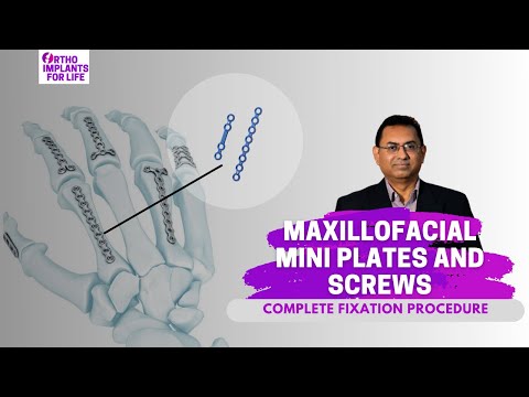 Medical grade self tapping orthomax orthopedic implants, thi...