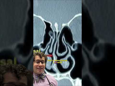 How to tell if you have a deviated nasal septum