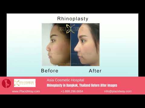 Asia Cosmetic Hospital's Rhinoplasty in Bangkok, Thailand Before and After Transformations