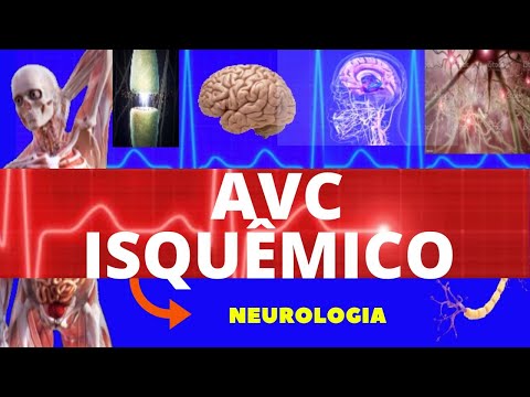 ACIDENTE VASCULAR CEREBRAL ISQUÊMICO (CAUSAS, SINTOMAS, DIAGNÓSTICO E TRATAMENTO) - AVC ISQUÊMICO