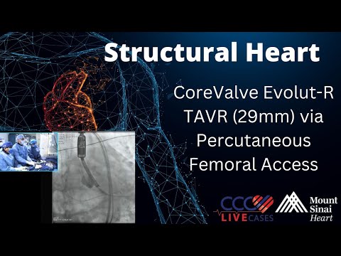 CoreValve Evolut-R TAVR (29mm) via Percutaneous Femoral Access - December 2015 Structural Live Case
