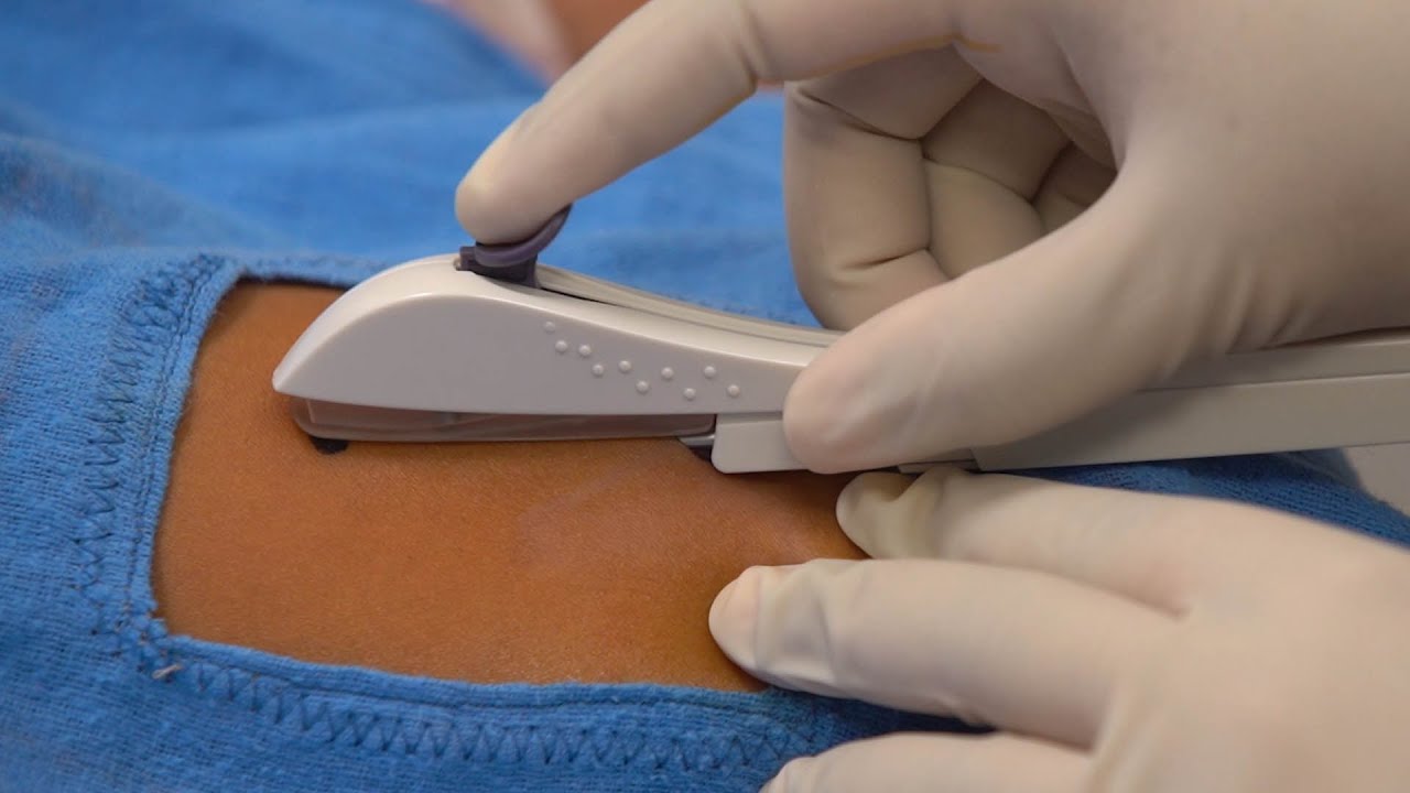 Where should nexplanon be inserted?