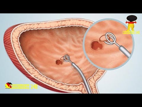 Blut im Urin nach einer Tour durch BPH Steinöl und Behandlung von Prostatitis