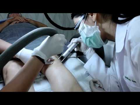 รายการ รู้ทันสวย | แนะนำเลเซอร์กำจัดขนถาวร - Evo series laser - Laser Permanent Hair reduction