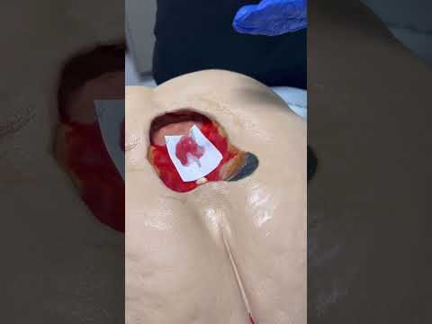 HOW TO APPLY COLLAGEN WOUND DRESSINGS