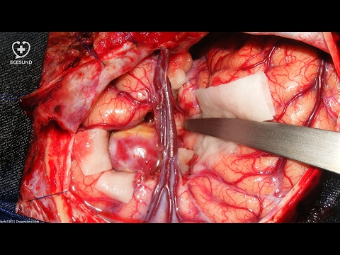 Eine Pumpe zur Blutdruckmessung Kopf kindlichen Gehirns Hypertension